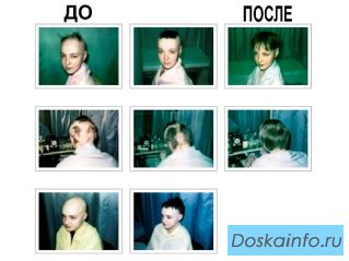 Лечение облысения, алопеции и             выпадения волос.