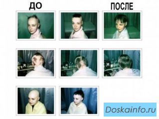 Лечение      облысения,   алопеции         и выпадения волос.